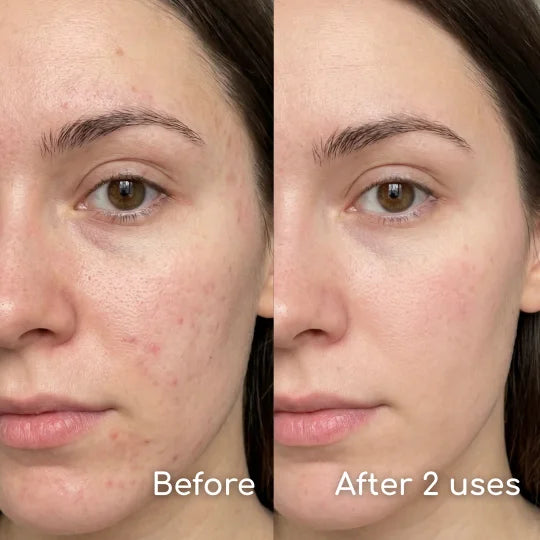 One patch. Whole face-The first-ever full-face hydrocolloid pimple patch